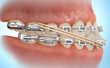 All About Elastics - Bronsky Orthodontics